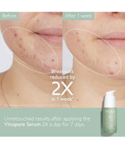 Cargar imagen en el visor de la galería, Caudalie Acne-Prone Skin Essentials Set