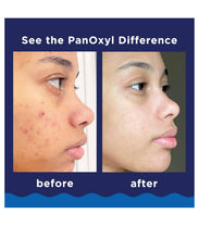 Cargar imagen en el visor de la galería, Panoxyl Acné Foaming Wash For Face & Body Limpiador